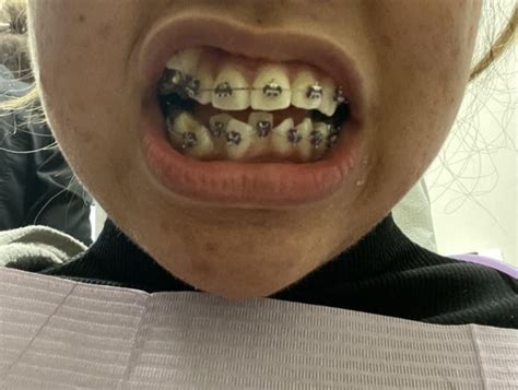 fastbraces reddit|Fastbraces Reviews .